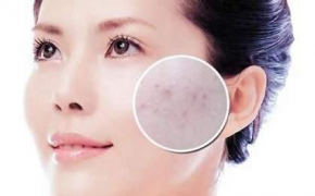 射频级高频电刀的应用：寻常性痤疮与痤疮瘢痕的美容整形